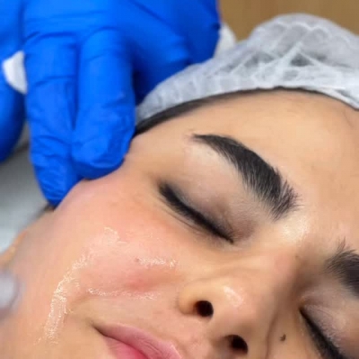 میکرونیدلینگ در رشت